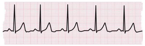 ECG strip showing normal heartbeat