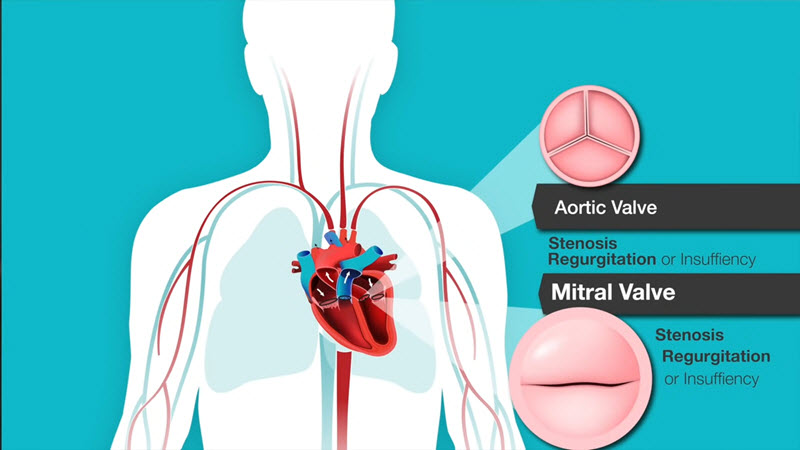 Understanding Heart Murmurs, Aortic and Mitral Valve Problems video screenshot